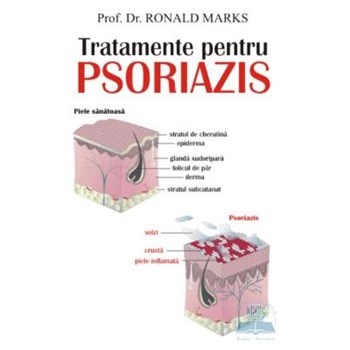 Tratamente pentru psoriazis - Ronald Marks 973-636-157-8